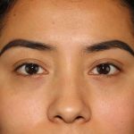 Eyelid Lift Before & After Patient #1682