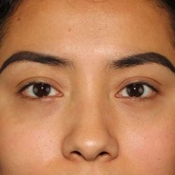 Eyelid Lift Before & After Patient #1682
