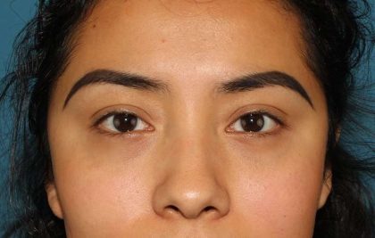 Eyelid Lift Before & After Patient #1682