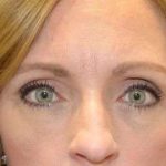 Eyelid Lift Before & After Patient #1685