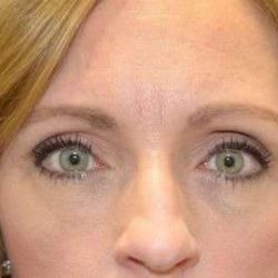 Eyelid Lift Before & After Patient #1685