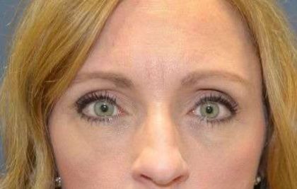 Eyelid Lift Before & After Patient #1685
