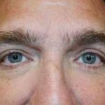 Eyelid Lift Before & After Patient #1688