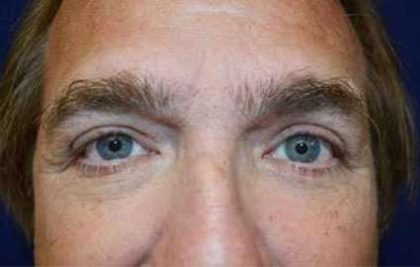 Eyelid Lift Before & After Patient #1688
