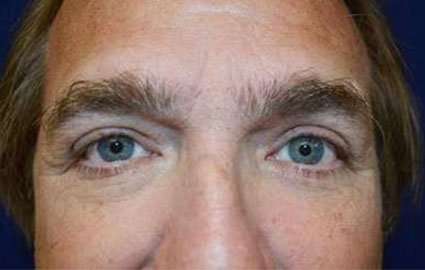 Eyelid Lift Before & After Patient #1688