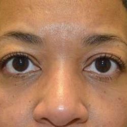Eyelid Lift Before & After Patient #1691