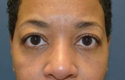 Eyelid Lift Before & After Patient #1691
