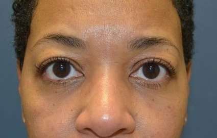Eyelid Lift Before & After Patient #1691
