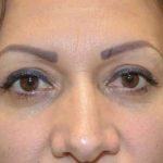 Eyelid Lift Before & After Patient #1694