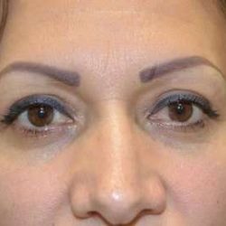 Eyelid Lift Before & After Patient #1694
