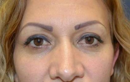 Eyelid Lift Before & After Patient #1694