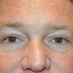 Eyelid Lift Before & After Patient #1697