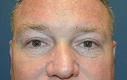 Eyelid Lift Before & After Patient #1697