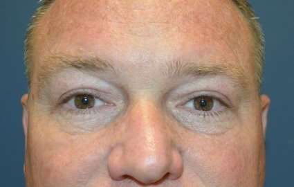 Eyelid Lift Before & After Patient #1697