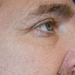 Eyelid Lift Before & After Patient #1700