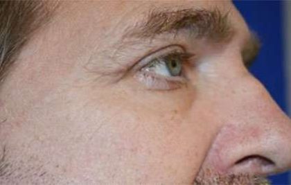 Eyelid Lift Before & After Patient #1700