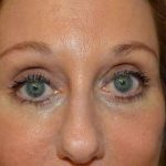Eyelid Lift Before & After Patient #1703