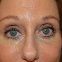 Eyelid Lift Before & After Patient #1703
