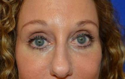 Eyelid Lift Before & After Patient #1703