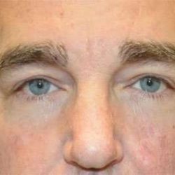 Eyelid Lift Before & After Patient #1706