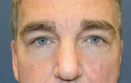 Eyelid Lift Before & After Patient #1706