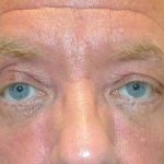 Eyelid Lift Before & After Patient #1709