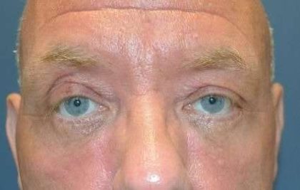 Eyelid Lift Before & After Patient #1709