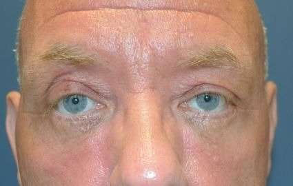 Eyelid Lift Before & After Patient #1709