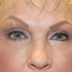 Eyelid Lift Before & After Patient #1712