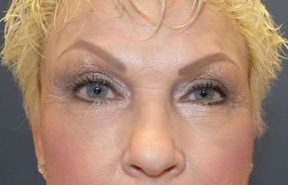 Eyelid Lift Before & After Patient #1712