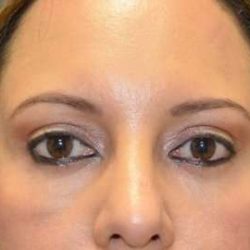 Eyelid Lift Before & After Patient #1715