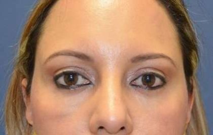 Eyelid Lift Before & After Patient #1715