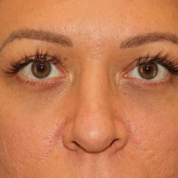 Eyelid Lift Before & After Patient #1718