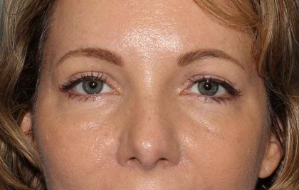 Eyelid Lift Before & After Patient #1736