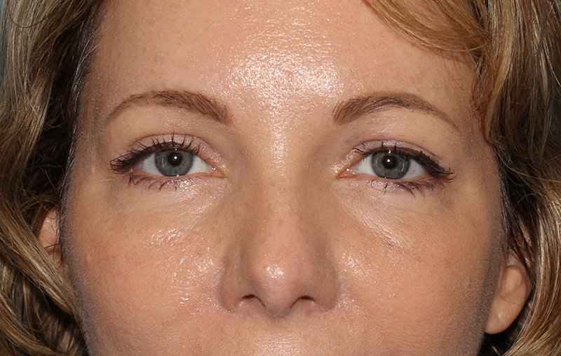 Eyelid Lift Before & After Patient #1736