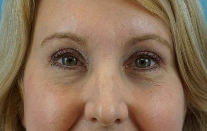 Eyelid Lift Before & After Patient #1747