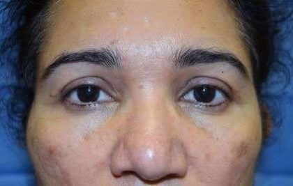 Eyelid Lift Before & After Patient #1750