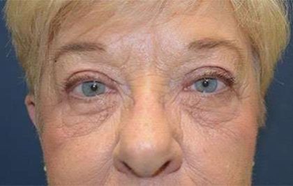 Eyelid Lift Before & After Patient #1756
