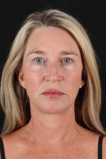 Facelift Before & After Patient #1778