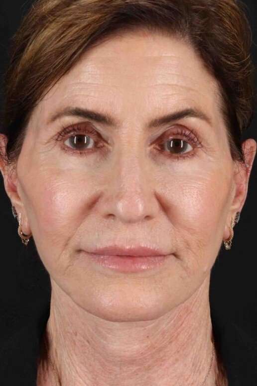Facelift Before & After Patient #1789