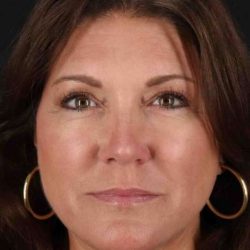 Facelift Before & After Patient #1800