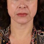 Facelift Before & After Patient #1809