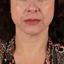 Facelift Before & After Patient #1809