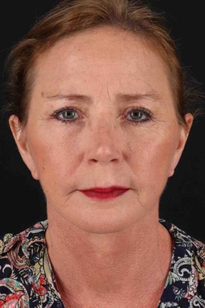 Facelift Before & After Patient #1831