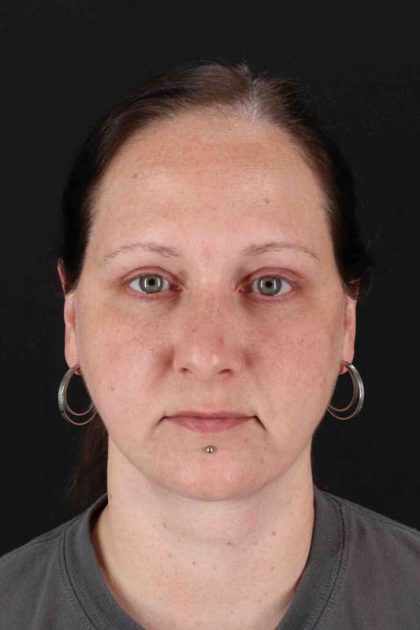 Facelift Before & After Patient #1843