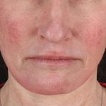 Facelift Before & After Patient #1866