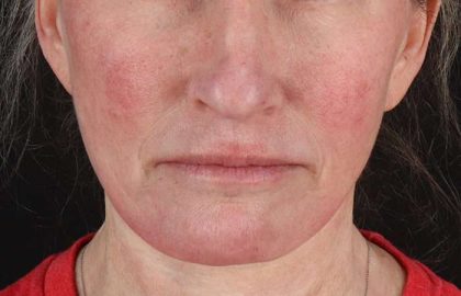 Facelift Before & After Patient #1866