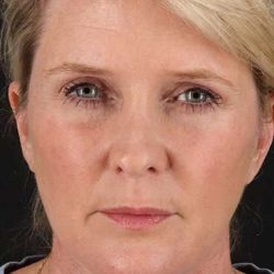 Facelift Before & After Patient #1877