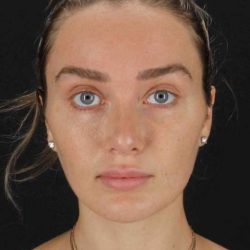 Browlift Before & After Patient #1297