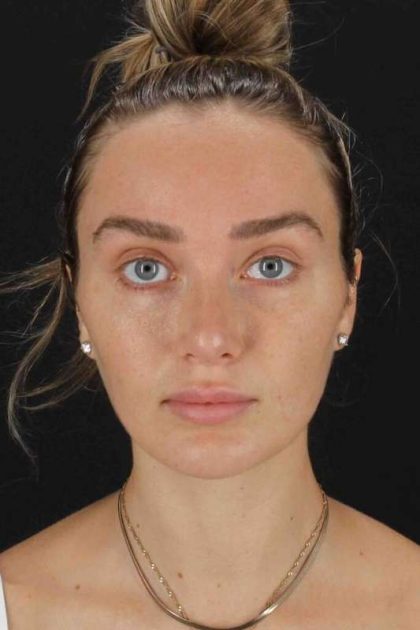 Browlift Before & After Patient #1297